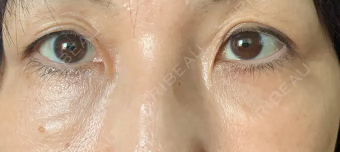 クマ治療 / 下まぶたたるみ取り / 脂肪注入（肌） 湘南美容クリニック 藤沢院 DAY 29 メイン用