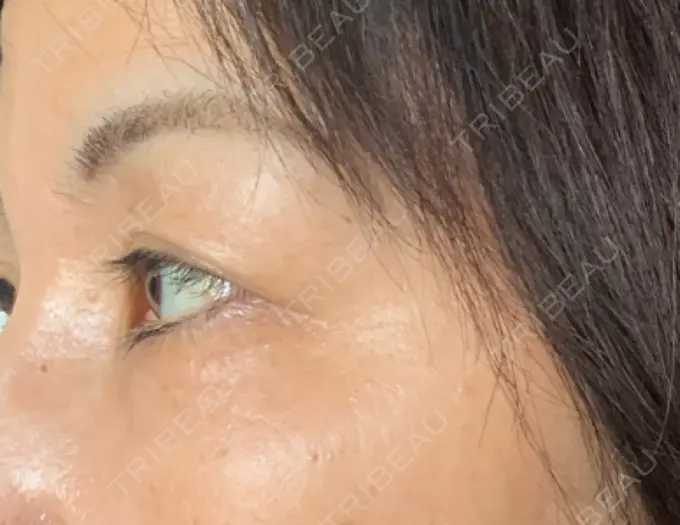 クマ治療 / 下まぶたたるみ取り / 脂肪注入（肌） 湘南美容クリニック 藤沢院 DAY 29 メイン用