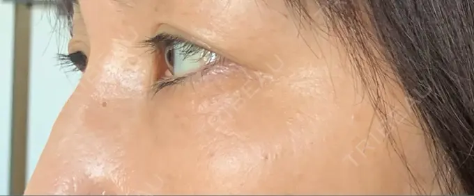 クマ治療 / 下まぶたたるみ取り / 脂肪注入（肌） 湘南美容クリニック 藤沢院 DAY 29 メイン用