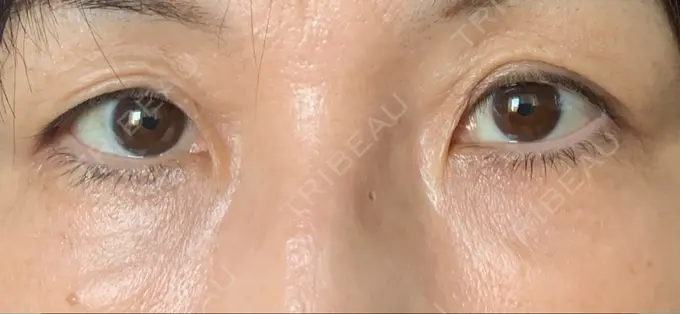 クマ治療 / 下まぶたたるみ取り / 脂肪注入（肌） 湘南美容クリニック 藤沢院 DAY 29 メイン用