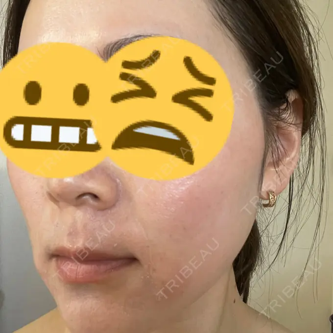 美肌レーザー まゆりなclinic 名古屋栄 AFTER メイン用