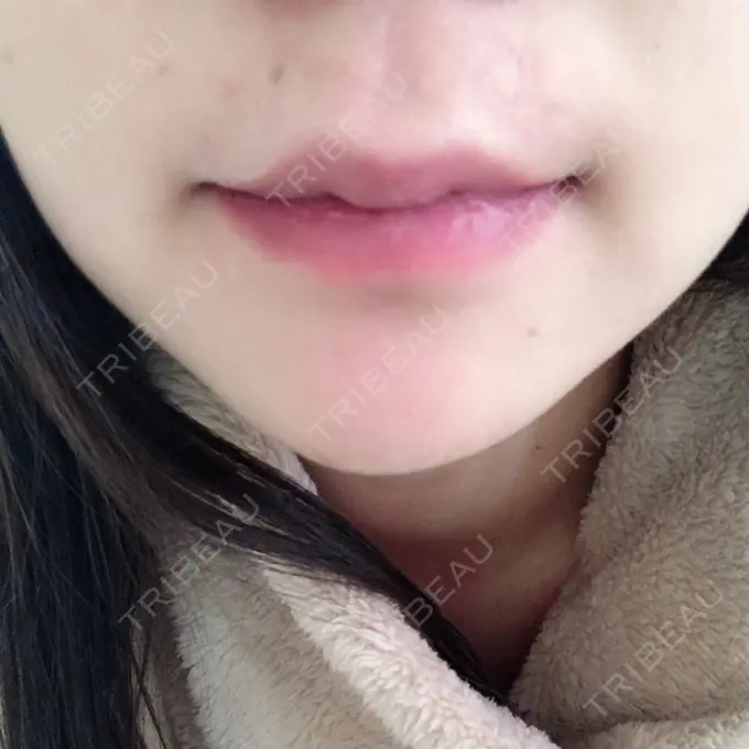 口唇縮小術 品川美容外科池袋院 DAY 42 メイン用