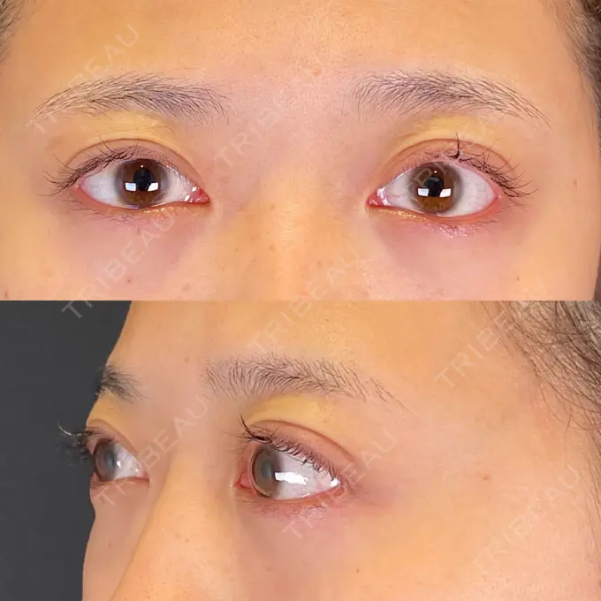 眼瞼下垂（非切開） SOL CLINIC DAY 0 メイン用