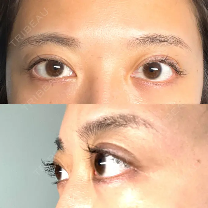 眼瞼下垂（非切開） SOL CLINIC DAY 1 メイン用