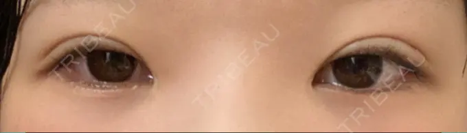 二重埋没 神戸元町ビューティークリニック AFTER メイン用