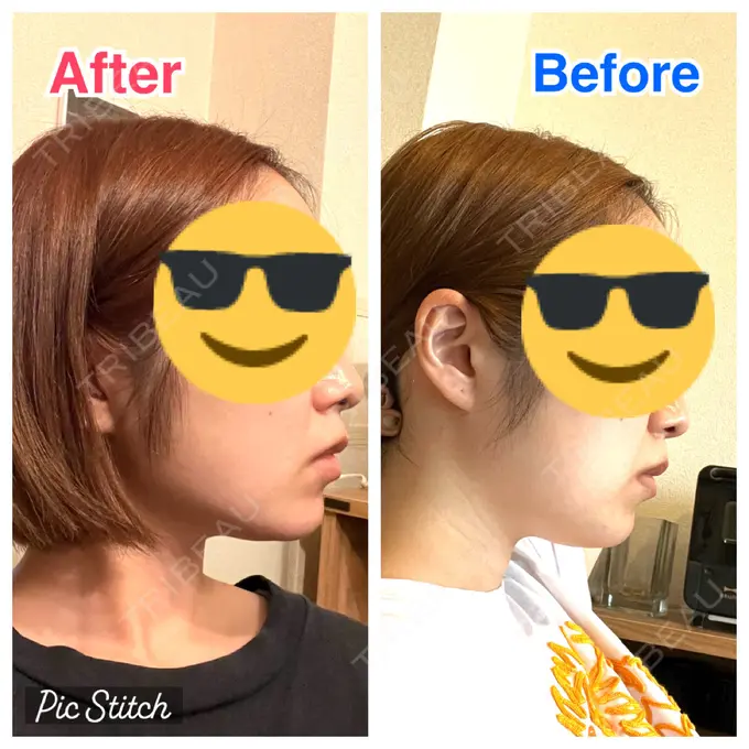 糸リフト / 脂肪吸引（顔） 東京シンデレラ美容外科 池袋院 AFTER メイン用