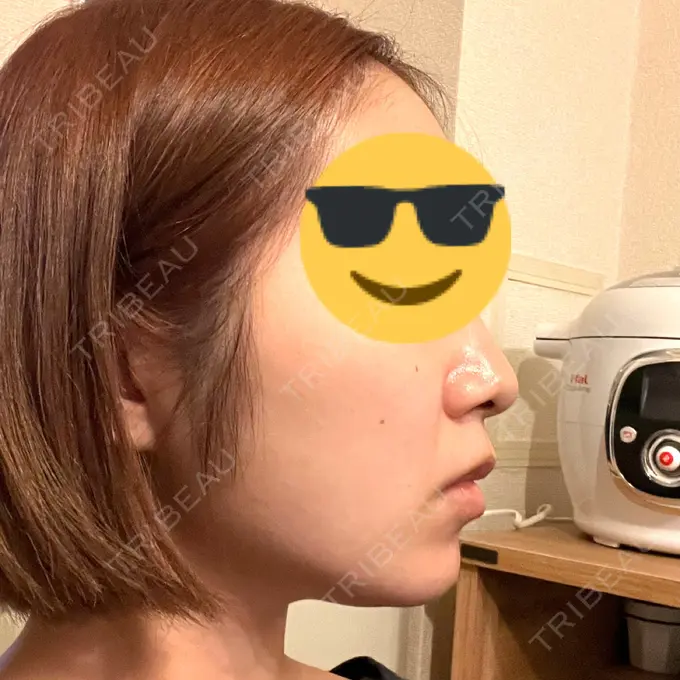 糸リフト / 脂肪吸引（顔） 東京シンデレラ美容外科 池袋院 DAY 32 メイン用