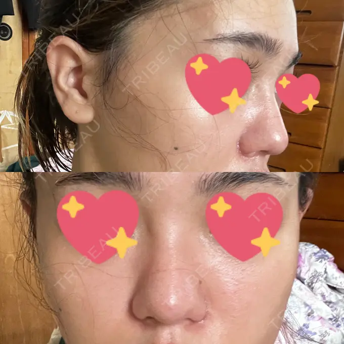 鼻中隔延長（切開） / 眉間プロテーゼ / 鼻尖縮小 / 鼻尖形成（非切開） YBC横浜美容外科 大宮院 AFTER メイン用