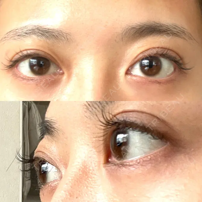 眼瞼下垂（非切開） SOL CLINIC DAY 2 メイン用