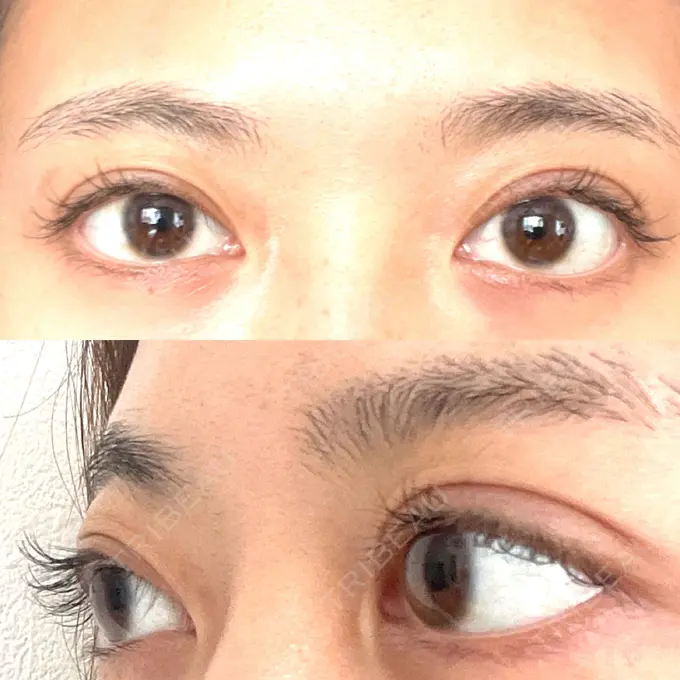 眼瞼下垂（非切開） SOL CLINIC DAY 3 メイン用