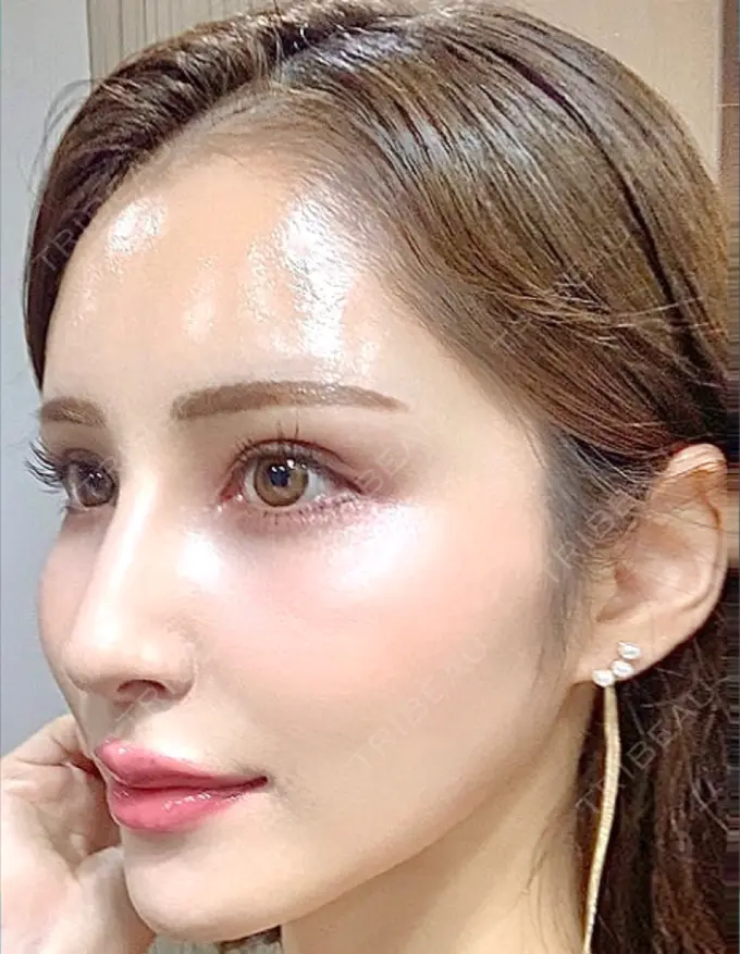 人中短縮 / ヒアルロン酸注入（唇） / ボトックス（口角） EMMO FACE CLINIC 大宮院 DAY 12 メイン用