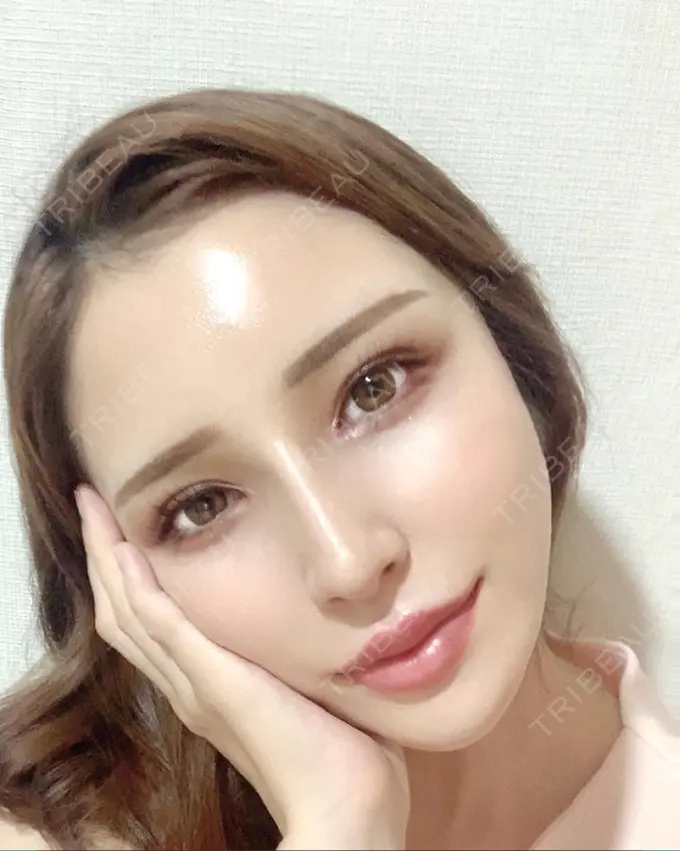 人中短縮 / ヒアルロン酸注入（唇） / ボトックス（口角） EMMO FACE CLINIC 大宮院 AFTER メイン用