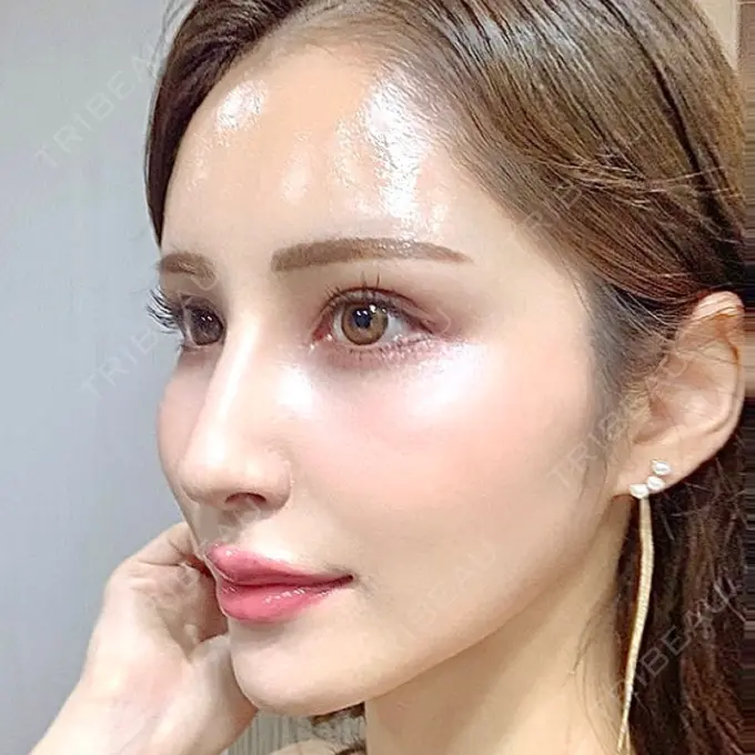 人中短縮 / ヒアルロン酸注入（唇） / ボトックス（口角） EMMO FACE CLINIC 大宮院 DAY 73 メイン用