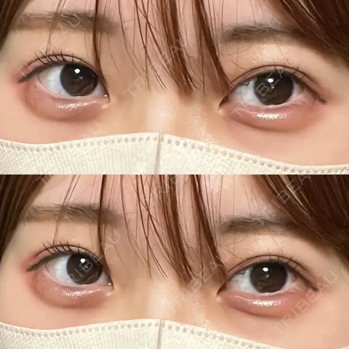 ヒアルロン酸注入（涙袋） 渋谷美容外科クリニック 渋谷院 DAY 0 メイン用