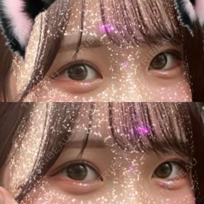 ヒアルロン酸注入（涙袋） 渋谷美容外科クリニック 渋谷院 DAY 15 メイン用