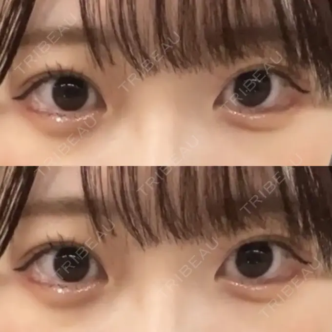 ヒアルロン酸注入（涙袋） 渋谷美容外科クリニック 渋谷院 AFTER メイン用