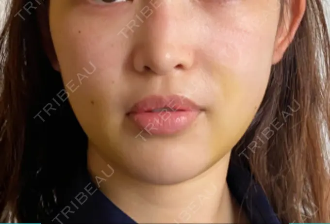 糸リフト / 脂肪吸引（顔） / ボトックス（エラ・小顔） HAAB×DREAM BEAUTY CLINIC 東京本院 DAY 7 メイン用