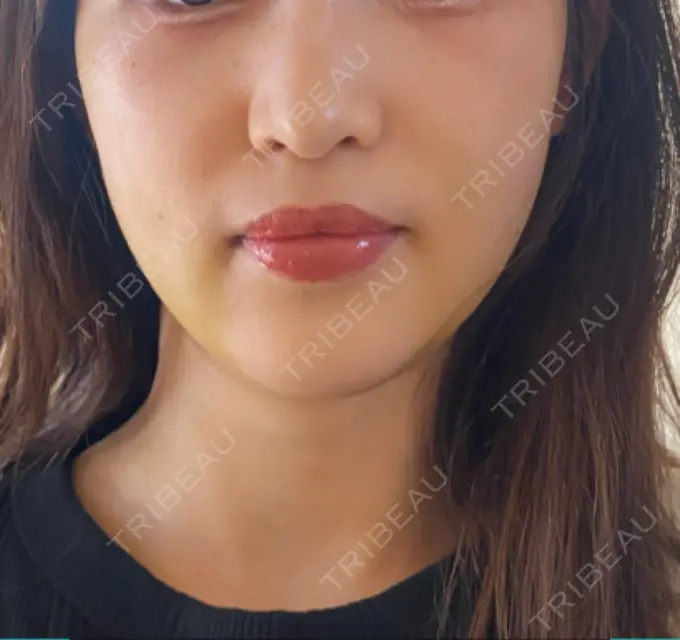 糸リフト / 脂肪吸引（顔） / ボトックス（エラ・小顔） HAAB×DREAM BEAUTY CLINIC 東京本院 DAY 7 メイン用