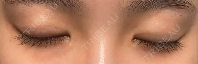 二重切開 こまちクリニック DAY 272 メイン用