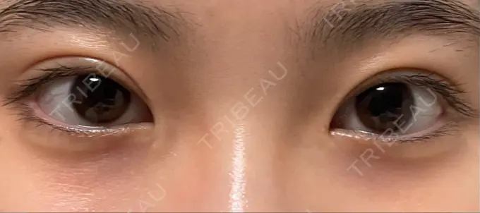 二重切開 こまちクリニック DAY 272 メイン用