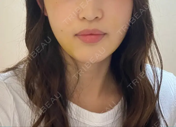 糸リフト / 脂肪吸引（顔） / ボトックス（エラ・小顔） HAAB×DREAM BEAUTY CLINIC 東京本院 DAY 8 メイン用