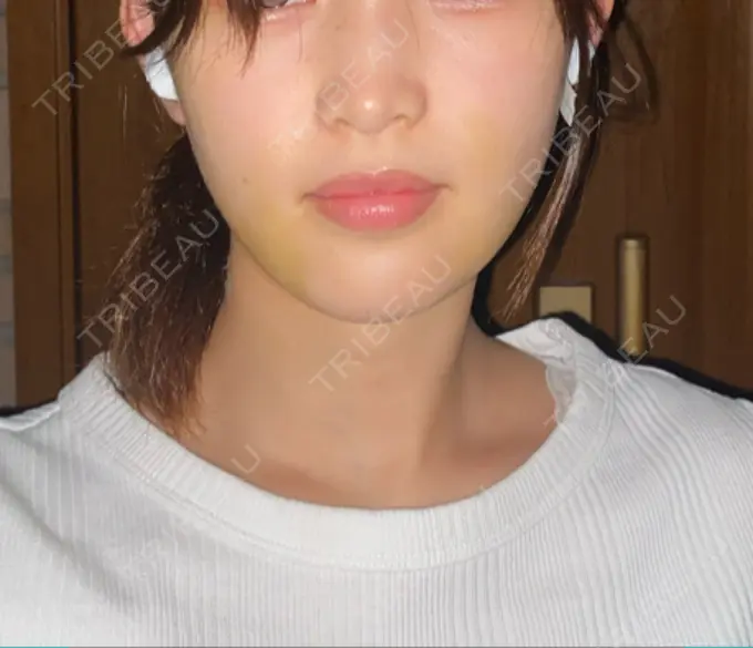 糸リフト / 脂肪吸引（顔） / ボトックス（エラ・小顔） HAAB×DREAM BEAUTY CLINIC 東京本院 DAY 8 メイン用