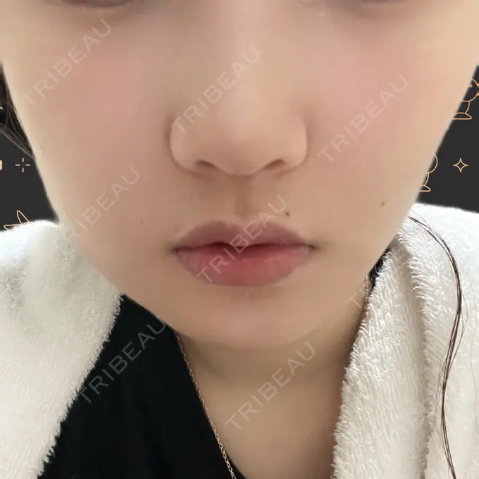 脂肪溶解注射（顔） 吉祥寺アイビークリニック DAY 3 メイン用