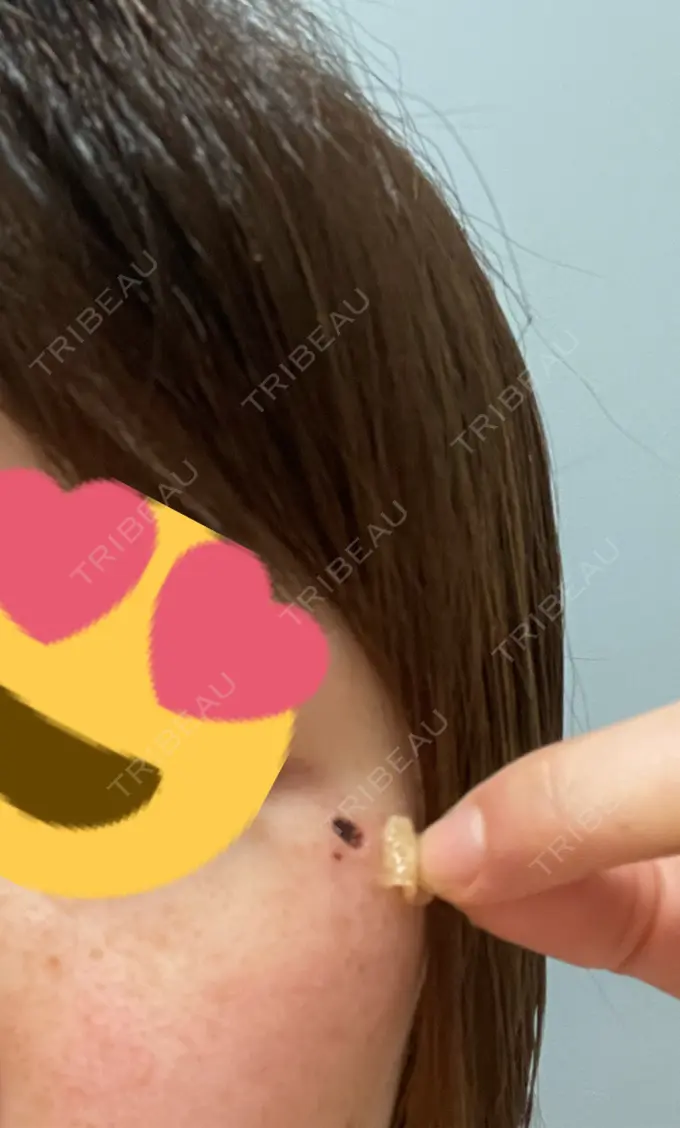 ほくろ・いぼ切除（肌） 吉祥寺アイビークリニック AFTER メイン用