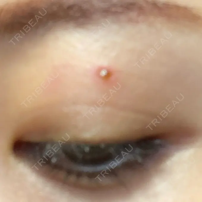 ほくろ・いぼ切除（肌） 吉祥寺アイビークリニック DAY 2 メイン用