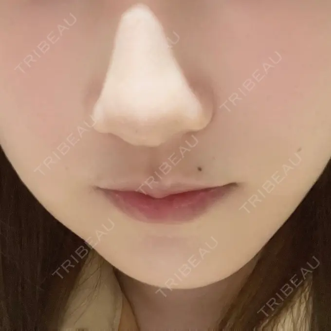 脂肪溶解注射（顔） 吉祥寺アイビークリニック DAY 5 メイン用