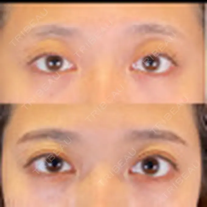 眼瞼下垂（非切開） SOL CLINIC DAY 7 メイン用