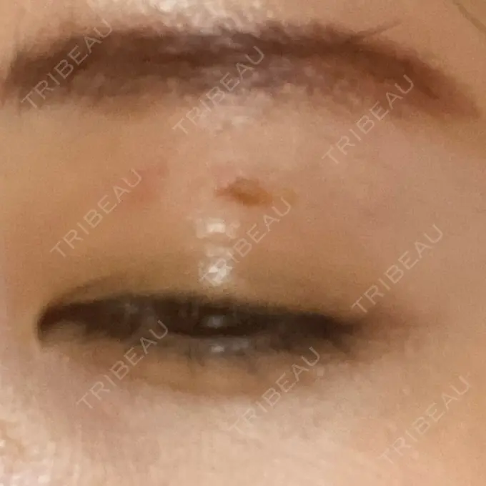 ほくろ・いぼ切除（肌） 吉祥寺アイビークリニック AFTER メイン用