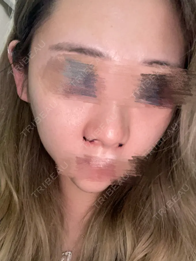 小鼻縮小（切開） / ヒアルロン酸注入（鼻） / ボトックス（エラ・小顔） / その他（鼻） 吉祥寺アイビークリニック DAY 1 メイン用