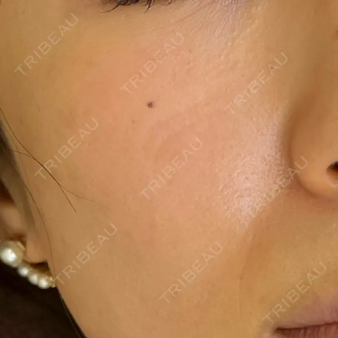 ピコレーザートーニング（美白・肝斑） design beauty clinic 梅田本院 AFTER メイン用