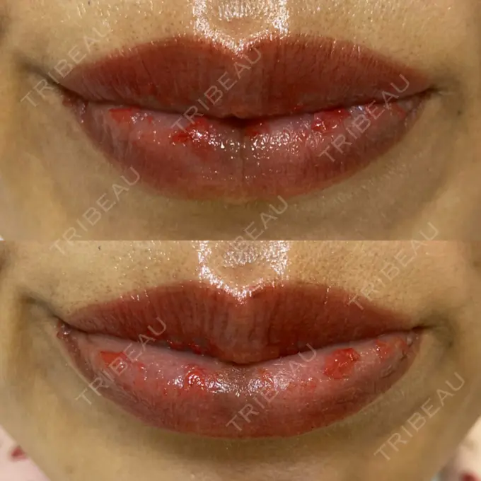 アートメイク（唇） エールクリニック 大阪心斎橋 DAY 2 メイン用