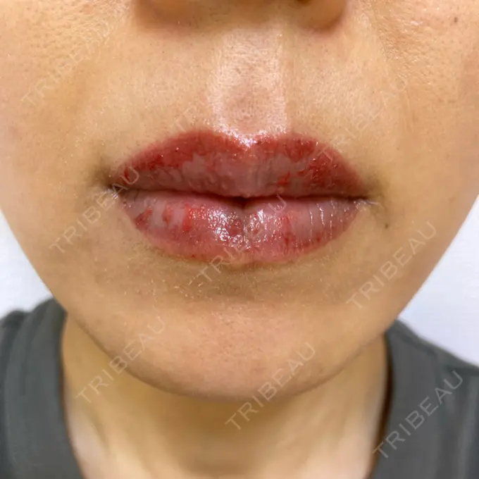 アートメイク（唇） エールクリニック 大阪心斎橋 DAY 3 メイン用