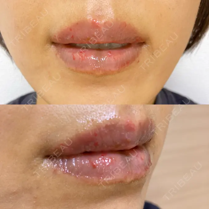 アートメイク（唇） エールクリニック 大阪心斎橋 DAY 4 メイン用