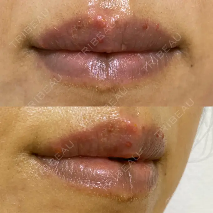 アートメイク（唇） エールクリニック 大阪心斎橋 DAY 5 メイン用