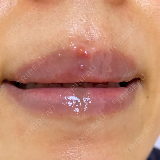 アートメイク（唇） エールクリニック 大阪心斎橋 DAY 6 メイン用