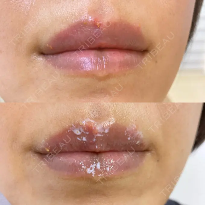 アートメイク（唇） エールクリニック 大阪心斎橋 DAY 7 メイン用