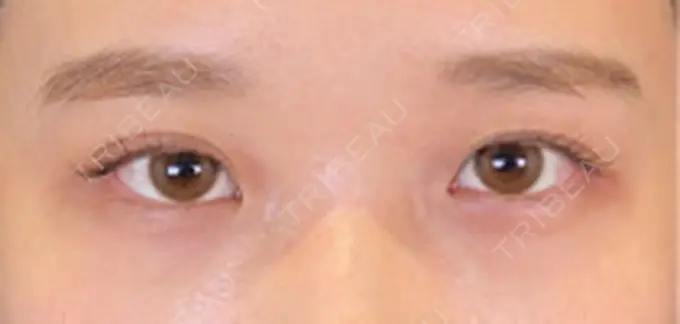 二重埋没 SOL CLINIC DAY 10 メイン用