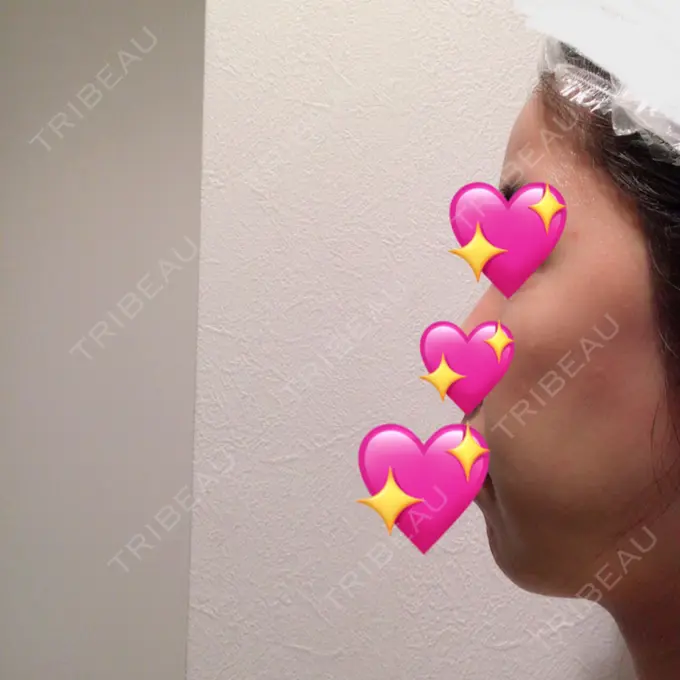 糸リフト / バッカルファット除去 / 脂肪吸引（顔） / メーラーファット除去 / ジョールファット除去 / ボトックス（エラ・小顔） / その他（輪郭） 湘南美容クリニック 秋葉原院 DAY 10 メイン用