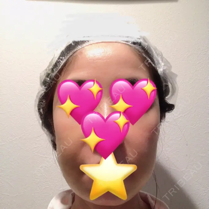 糸リフト / バッカルファット除去 / 脂肪吸引（顔） / メーラーファット除去 / ジョールファット除去 / ボトックス（エラ・小顔） / その他（輪郭） 湘南美容クリニック 秋葉原院 DAY 10 メイン用