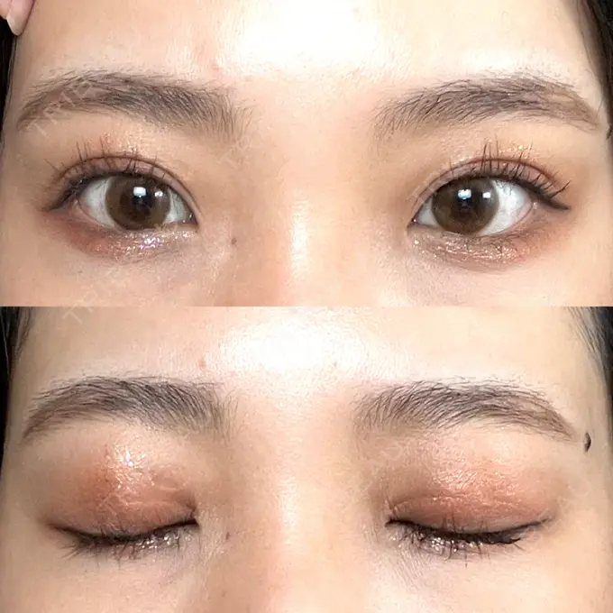 二重切開 / その他（目元） LIKI CLINIC KOBE DAY 109 メイン用