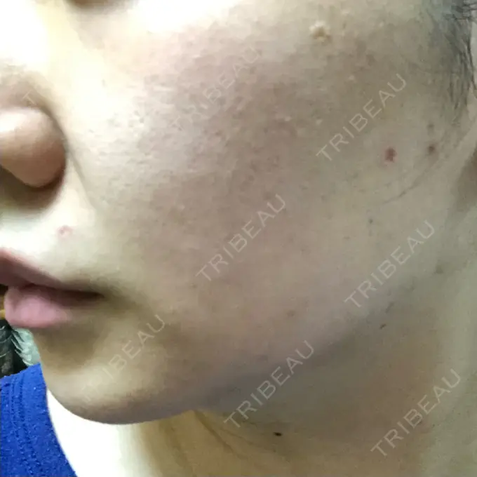 ほくろ・いぼ切除（肌） 吉祥寺アイビークリニック DAY 2 メイン用