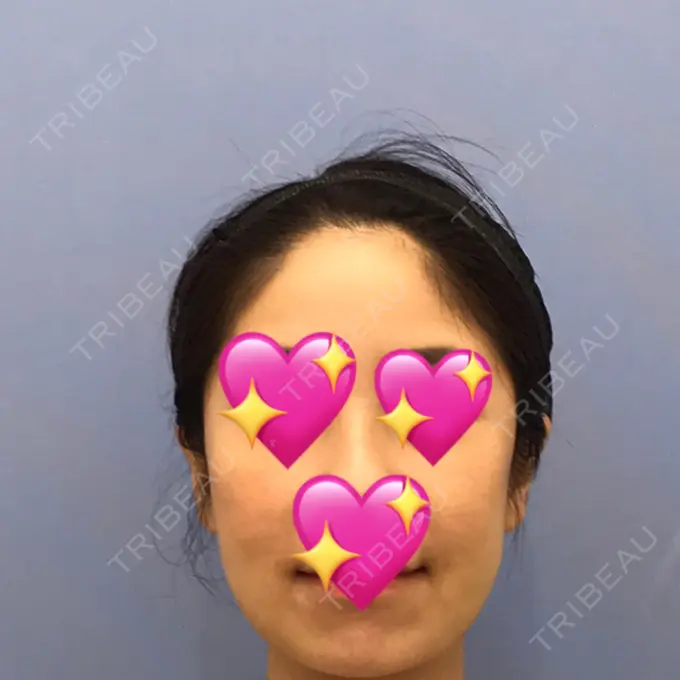 糸リフト / バッカルファット除去 / 脂肪吸引（顔） / メーラーファット除去 / ジョールファット除去 / ボトックス（エラ・小顔） / その他（輪郭） 湘南美容クリニック 秋葉原院 DAY 32 メイン用