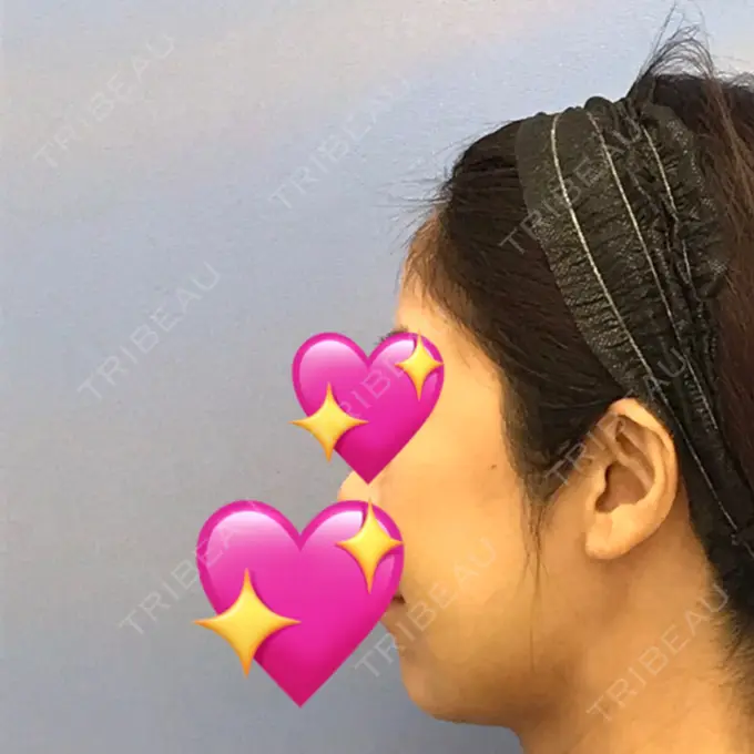 糸リフト / バッカルファット除去 / 脂肪吸引（顔） / メーラーファット除去 / ジョールファット除去 / ボトックス（エラ・小顔） / その他（輪郭） 湘南美容クリニック 秋葉原院 DAY 32 メイン用