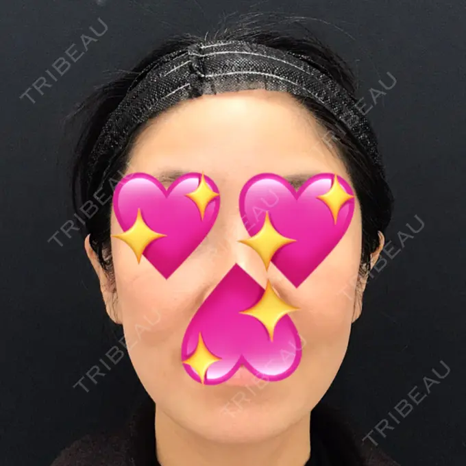 糸リフト / バッカルファット除去 / 脂肪吸引（顔） / メーラーファット除去 / ジョールファット除去 / ボトックス（エラ・小顔） / その他（輪郭） 湘南美容クリニック 秋葉原院 DAY 108 メイン用