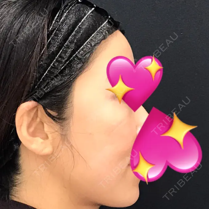 糸リフト / バッカルファット除去 / 脂肪吸引（顔） / メーラーファット除去 / ジョールファット除去 / ボトックス（エラ・小顔） / その他（輪郭） 湘南美容クリニック 秋葉原院 DAY 108 メイン用