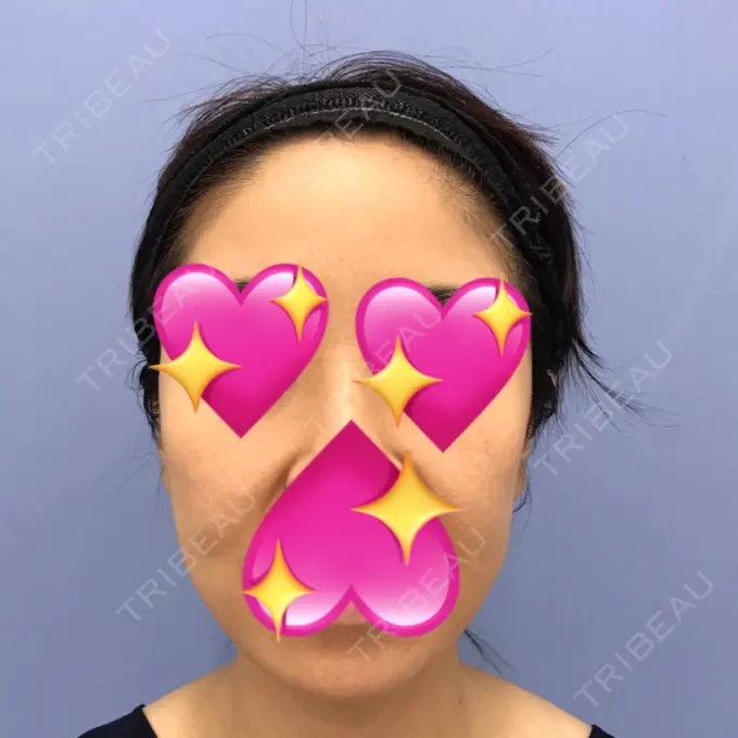 糸リフト / バッカルファット除去 / 脂肪吸引（顔） / メーラーファット除去 / ジョールファット除去 / ボトックス（エラ・小顔） / その他（輪郭） 湘南美容クリニック 秋葉原院 AFTER メイン用